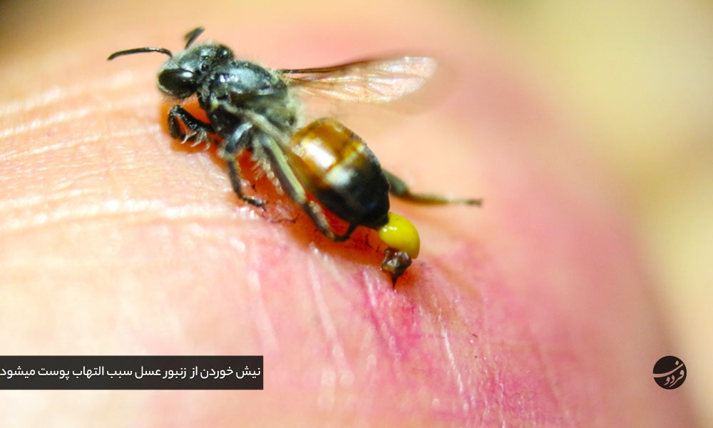 زهر- زنبور- عسل - التهاب- پوست-